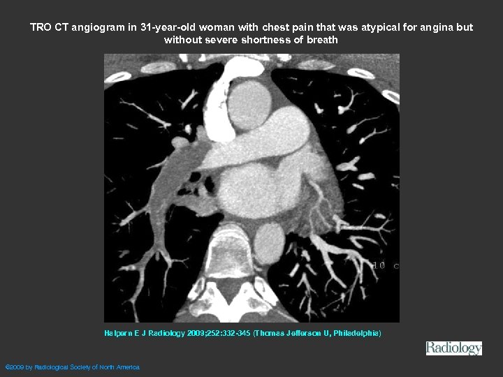 TRO CT angiogram in 31 -year-old woman with chest pain that was atypical for