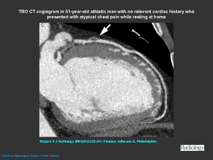 TRO CT angiogram in 51 -year-old athletic man with no relevant cardiac history who