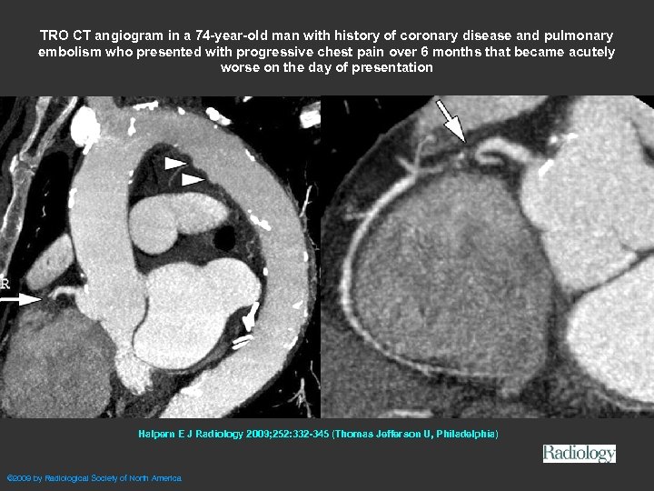 TRO CT angiogram in a 74 -year-old man with history of coronary disease and