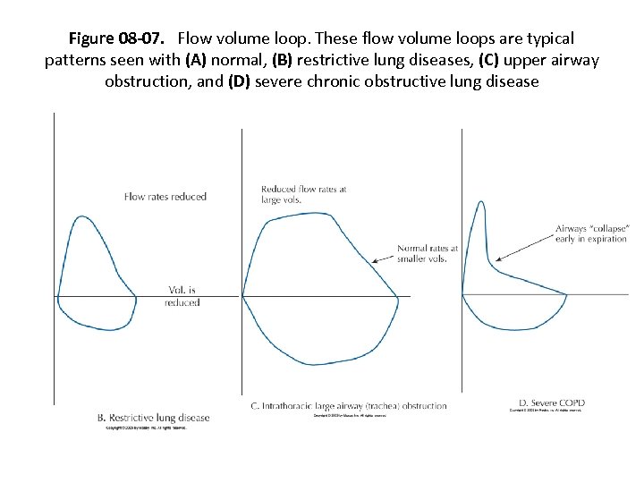 Figure 08 -07. Flow volume loop. These flow volume loops are typical patterns seen