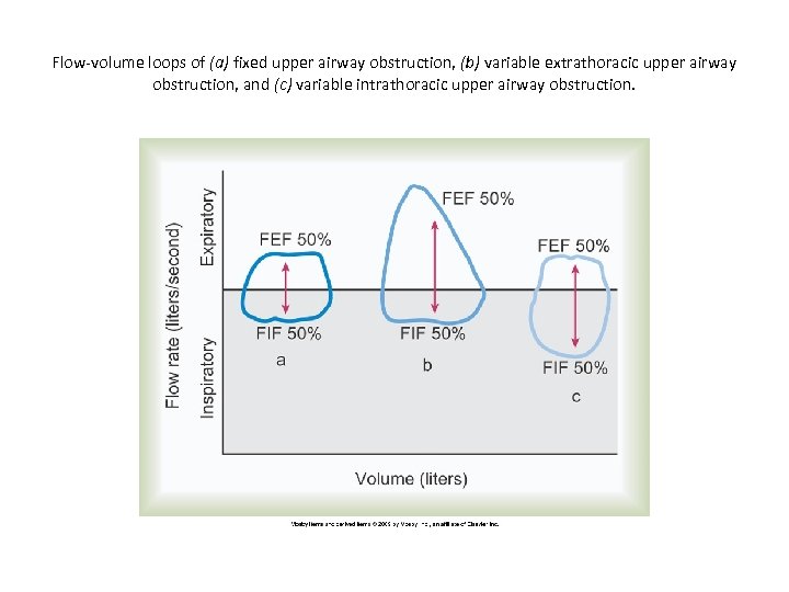 Flow-volume loops of (a) fixed upper airway obstruction, (b) variable extrathoracic upper airway obstruction,