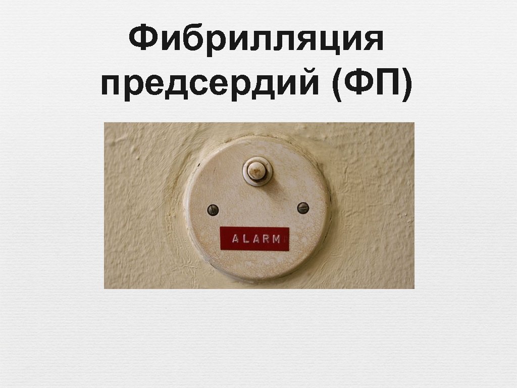 Фибрилляция предсердий (ФП) 