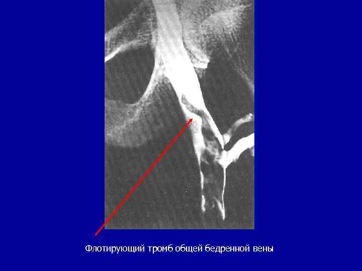 Тромбоз подвздошной вены фото