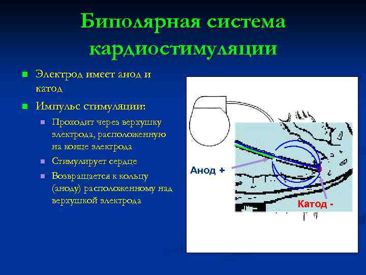 Биполярная система кардиостимуляции n n Электрод имеет анод и катод Импульс стимуляции: n n