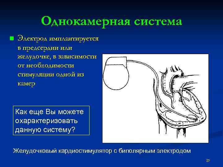 Однокамерная система n Электрод имплантируется в предсердии или желудочке, в зависимости от необходимости стимуляции
