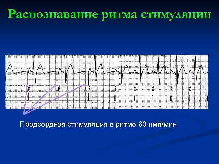 Распознавание ритма стимуляции Предсердная стимуляция в ритме 60 имп/мин 