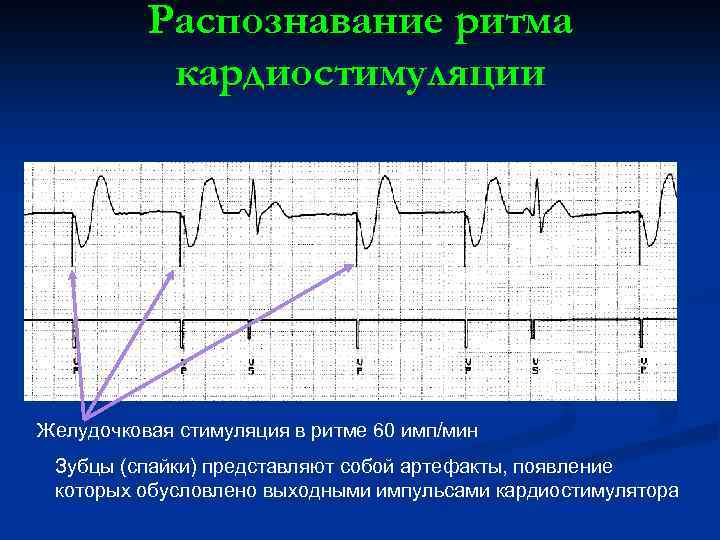 Распознавание ритма кардиостимуляции Желудочковая стимуляция в ритме 60 имп/мин Зубцы (спайки) представляют собой артефакты,