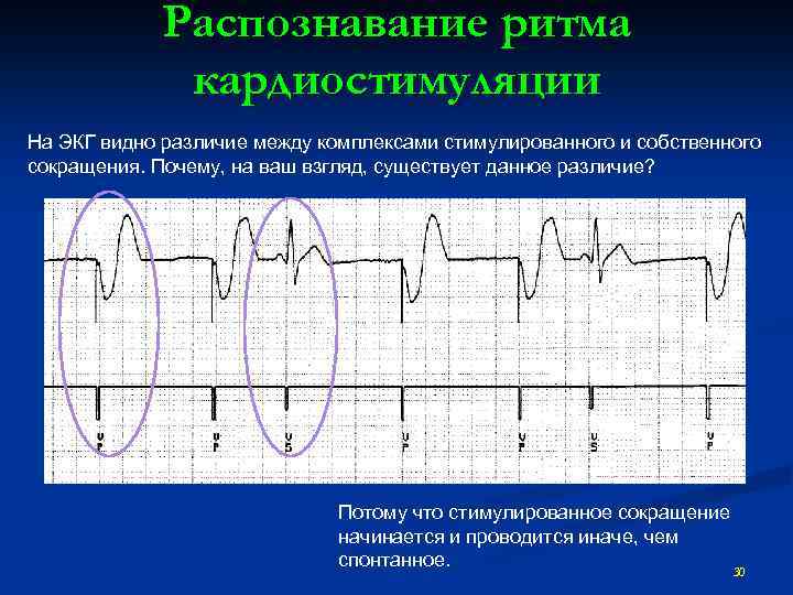 Распознавание ритма кардиостимуляции На ЭКГ видно различие между комплексами стимулированного и собственного сокращения. Почему,