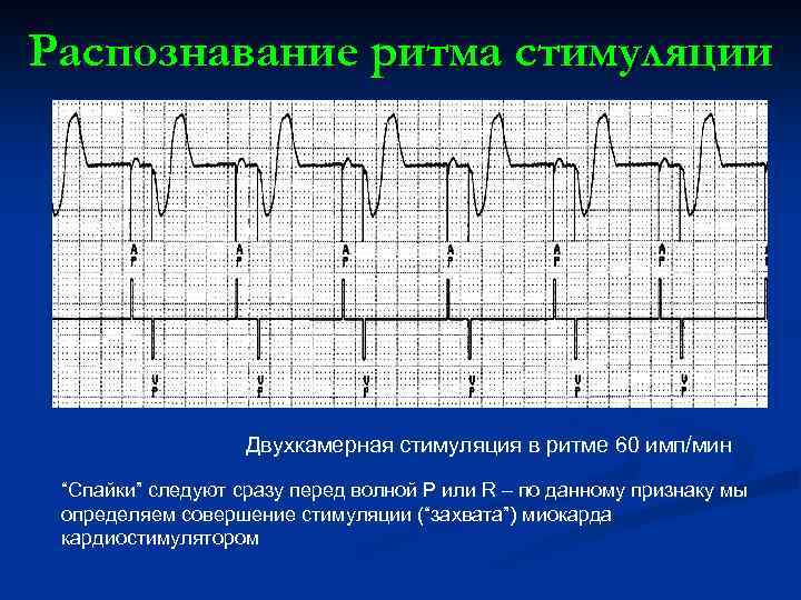 Распознавание ритма стимуляции Двухкамерная стимуляция в ритме 60 имп/мин “Спайки” следуют сразу перед волной