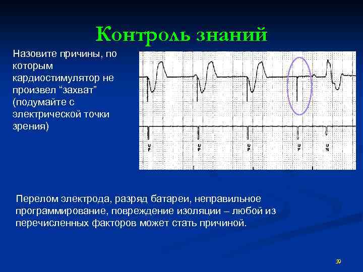 Экг с кардиостимулятором картинки