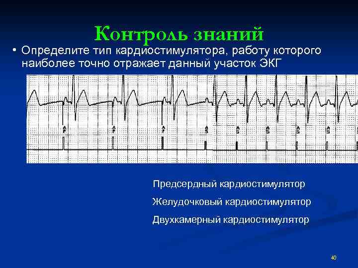 Контроль знаний • Определите тип кардиостимулятора, работу которого наиболее точно отражает данный участок ЭКГ