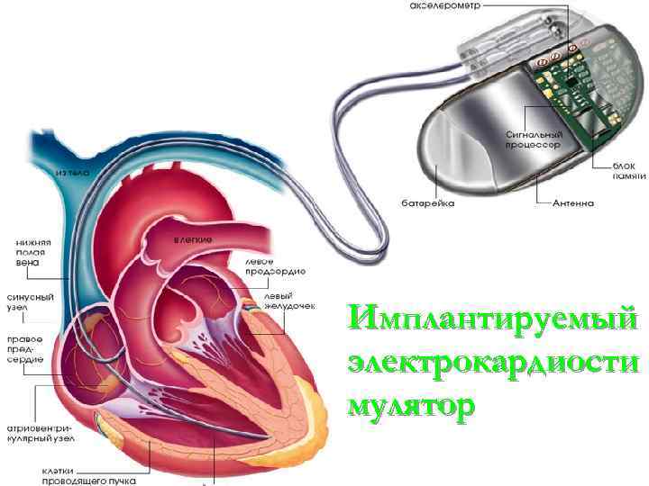 Имплантируемый электрокардиости мулятор 