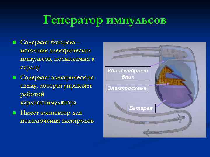 Генератор импульсов n n n Содержит батарею – источник электрических импульсов, посылаемых к сердцу