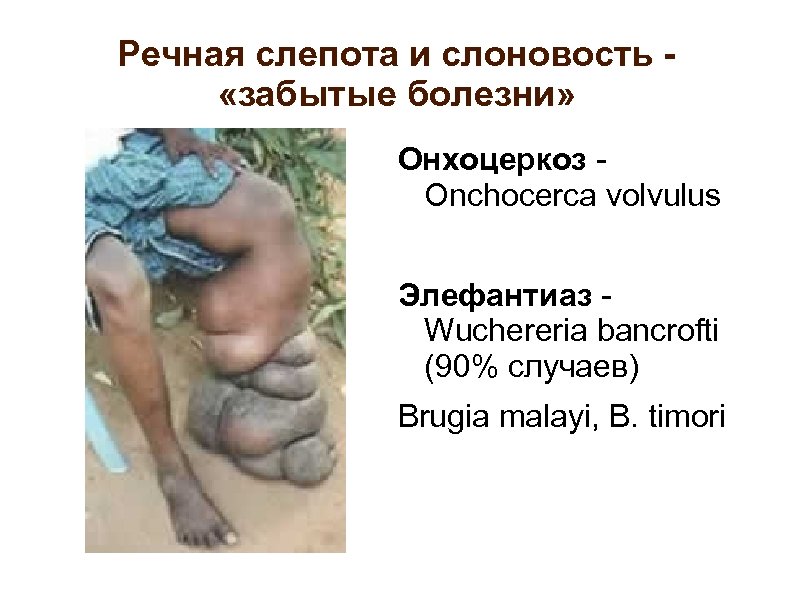 Речная слепота и слоновость «забытые болезни» Онхоцеркоз Onchocerca volvulus Элефантиаз Wuchereria bancrofti (90% случаев)