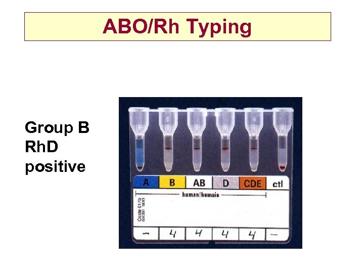 ABO/Rh Typing Group B Rh. D positive 