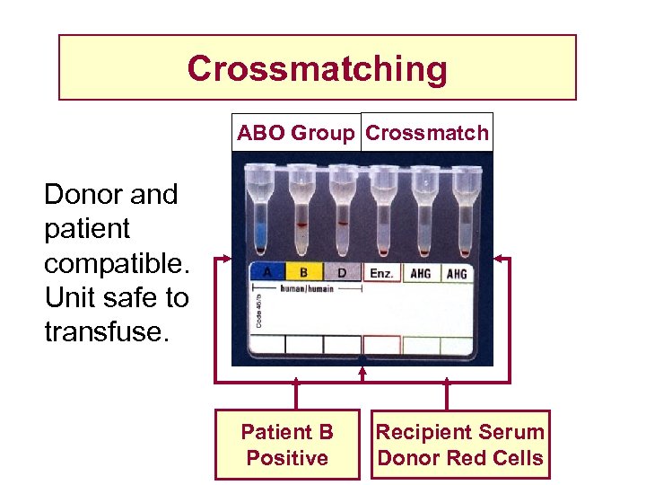 Crossmatching ABO Group Crossmatch Donor and patient compatible. Unit safe to transfuse. Patient B