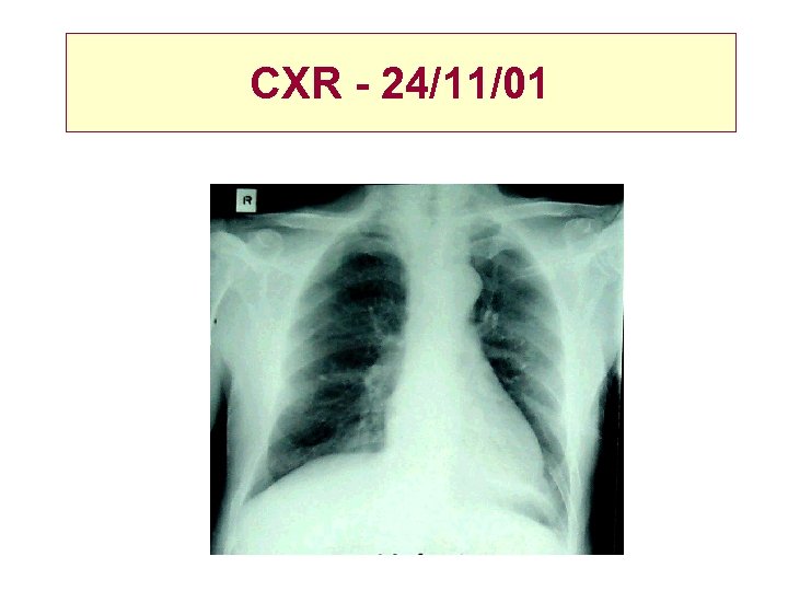 CXR - 24/11/01 