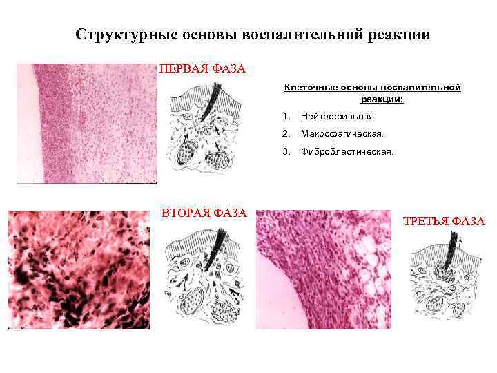 Схемы воспалительную реакцию тканей на внедрение микробов