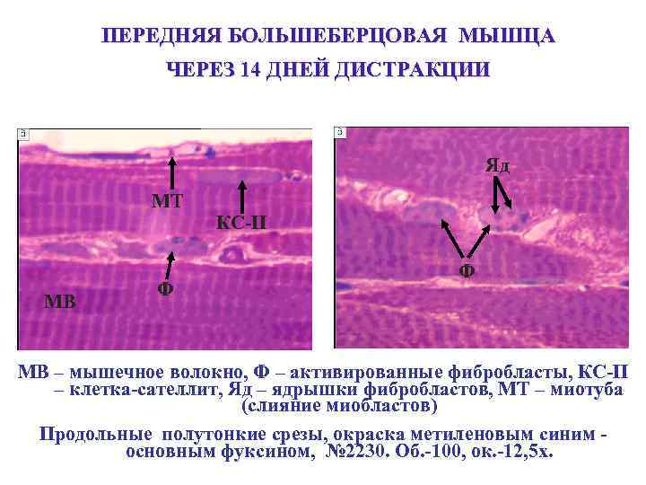 ПЕРЕДНЯЯ БОЛЬШЕБЕРЦОВАЯ МЫШЦА ЧЕРЕЗ 14 ДНЕЙ ДИСТРАКЦИИ Яд МТ МВ Ф КС-II Ф МВ