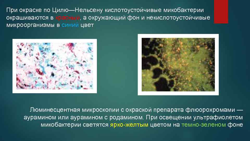 При окраске по Цилю—Нельсену кислотоустойчивые микобактерии окрашиваются в красный, а окружающий фон и некислотоустойчивые