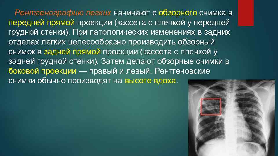 Рентгенографию легких начинают с обзорного снимка в передней прямой проекции (кассета с пленкой у