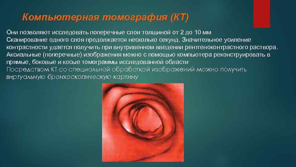 Компьютерная томография (КТ) Они позволяют исследовать поперечные слои толщиной от 2 до 10 мм