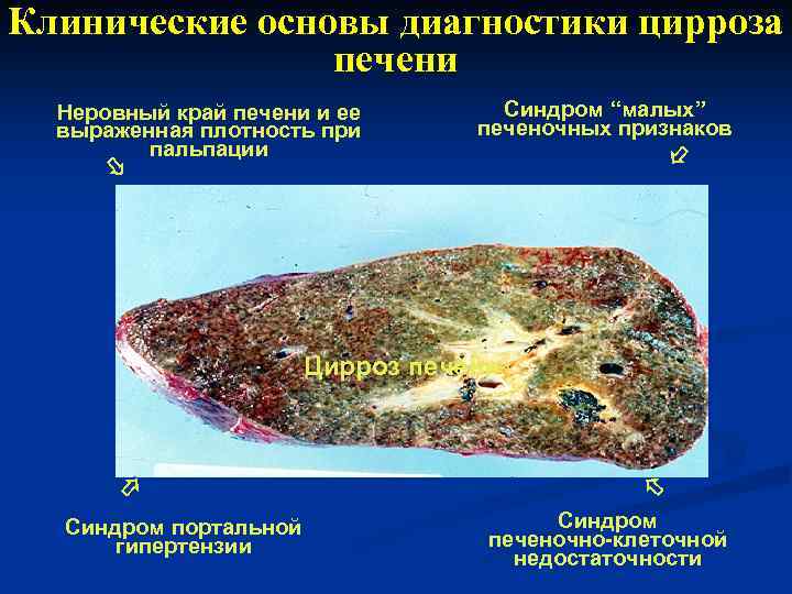 Клинические основы диагностики цирроза печени Синдром “малых” печеночных признаков Неровный край печени и ее