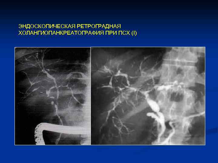 ЭНДОСКОПИЧЕСКАЯ РЕТРОГРАДНАЯ ХОЛАНГИОПАНКРЕАТОГРАФИЯ ПРИ ПСХ (I) 