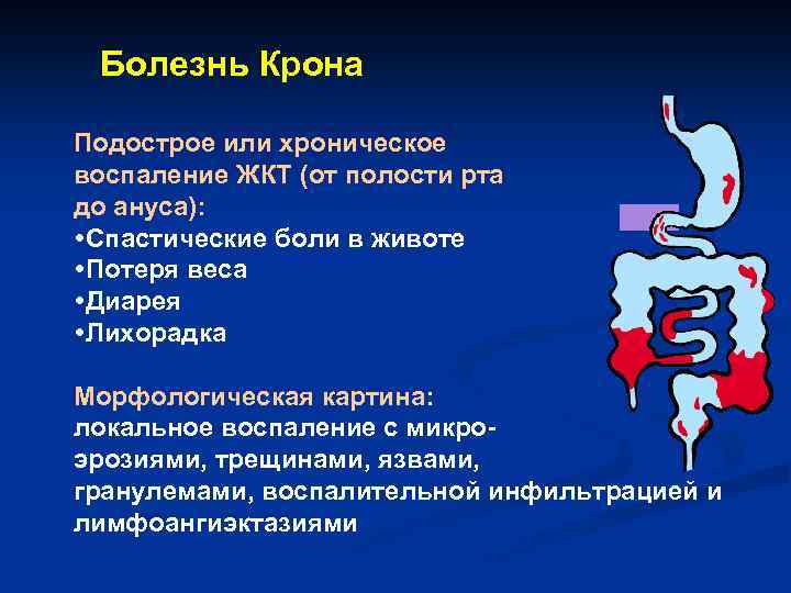 Болезнь Крона Подострое или хроническое воспаление ЖКТ (от полости рта до ануса): Спастические боли