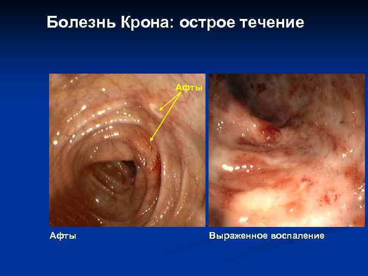 Болезнь Крона: острое течение Афты Выраженное воспаление 