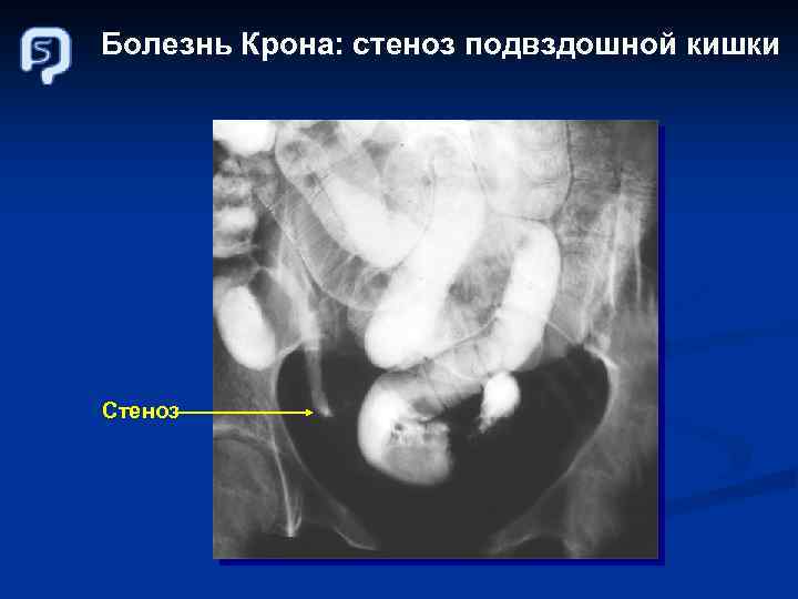 Болезнь Крона: стеноз подвздошной кишки Стеноз 