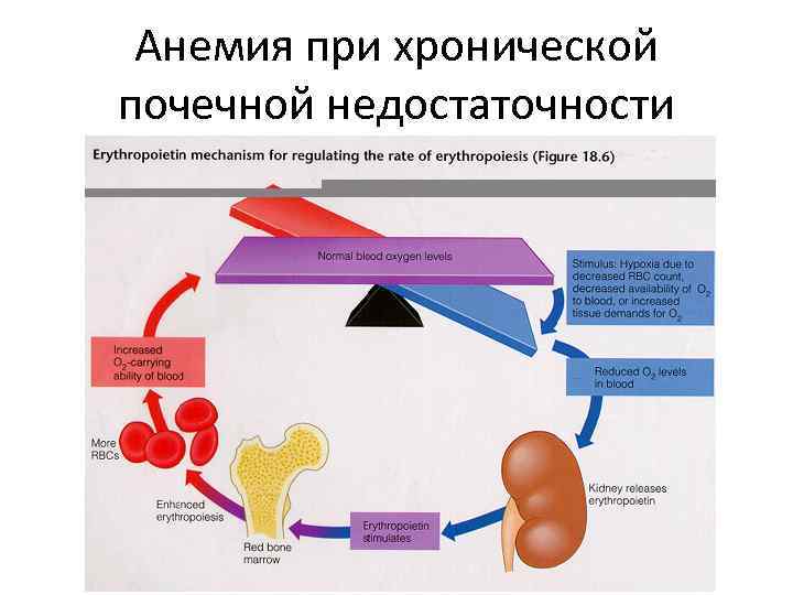 Анемия при хронической почечной недостаточности 