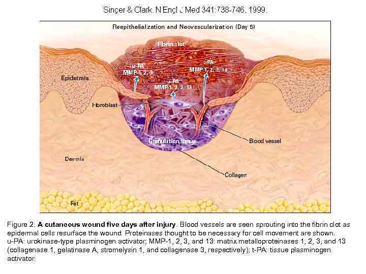 Figure 2. A cutaneous wound five days after injury. Blood vessels are seen sprouting