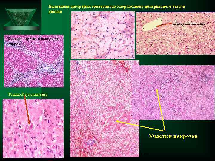 Баллонная дистрофия гепатоцитов с поражением центрального отдела дольки Центральная вена Коллапс стромы с исходом