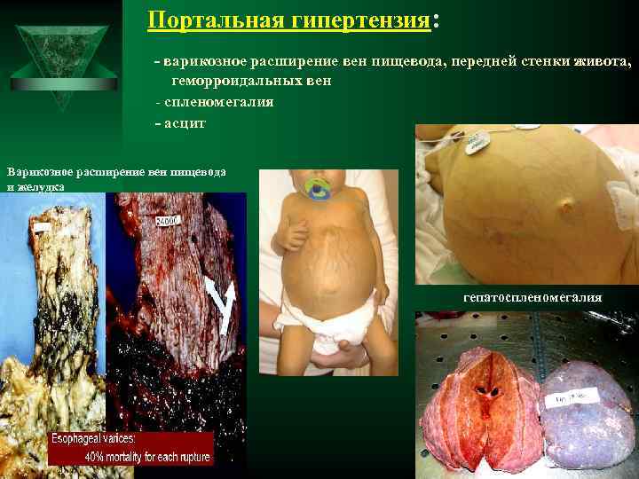 Портальная гипертензия: - варикозное расширение вен пищевода, передней стенки живота, геморроидальных вен - спленомегалия