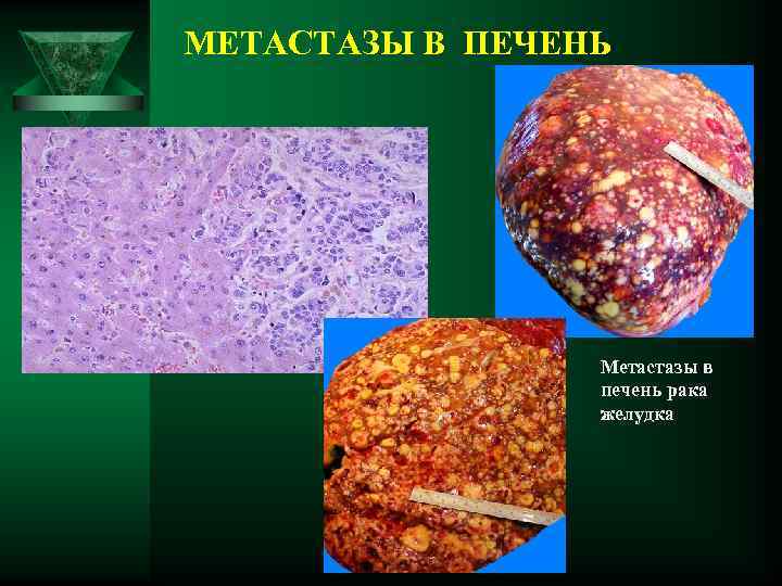 МЕТАСТАЗЫ В ПЕЧЕНЬ Метастазы в печень рака желудка 