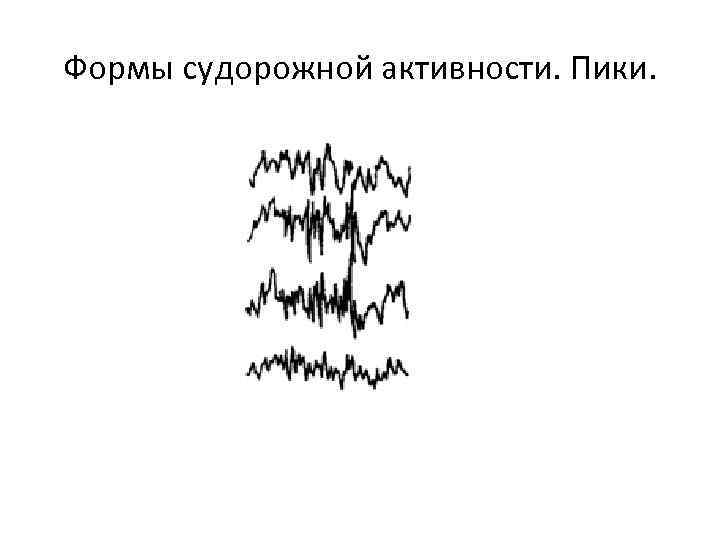 Формы судорожной активности. Пики. 