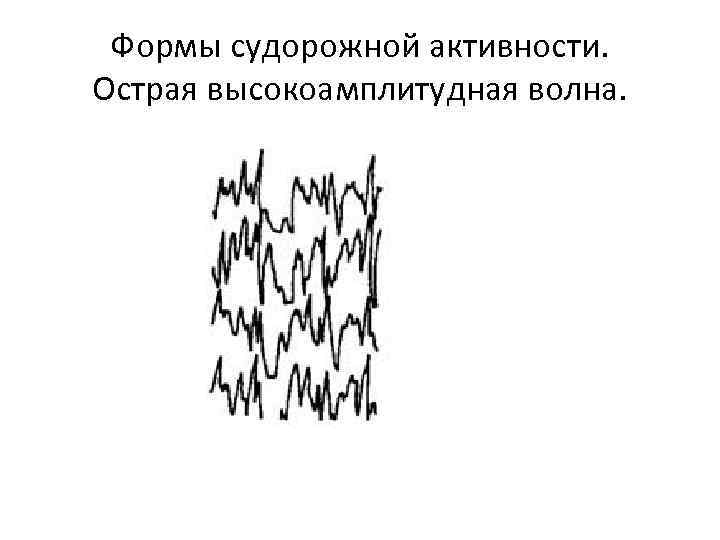 Формы судорожной активности. Острая высокоамплитудная волна. 