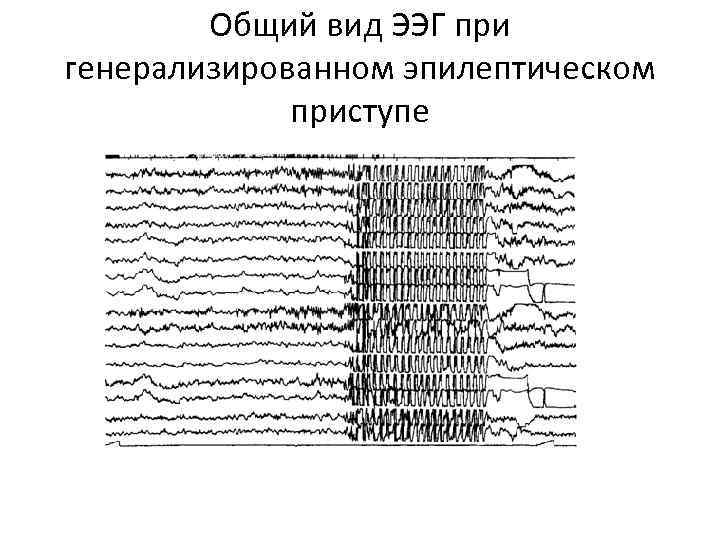 Общий вид ЭЭГ при генерализированном эпилептическом приступе 