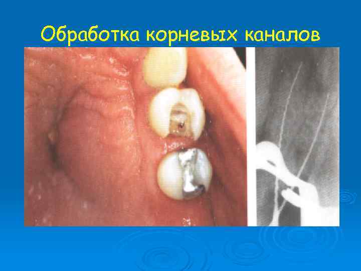 Обработка корневых каналов 