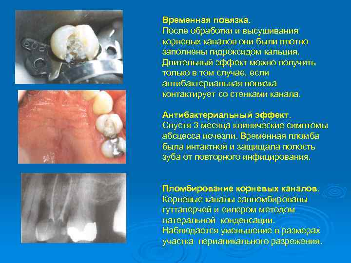 Временная повязка. После обработки и высушивания корневых каналов они были плотно заполнены гидроксидом кальция.