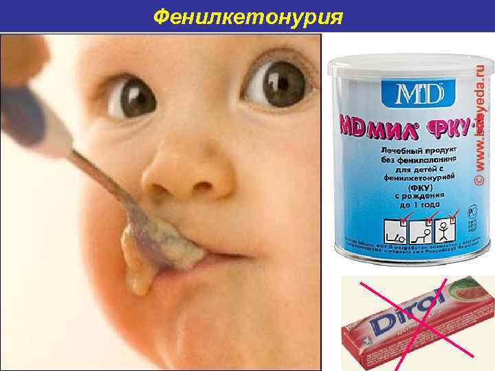 Фенилкетонурия 