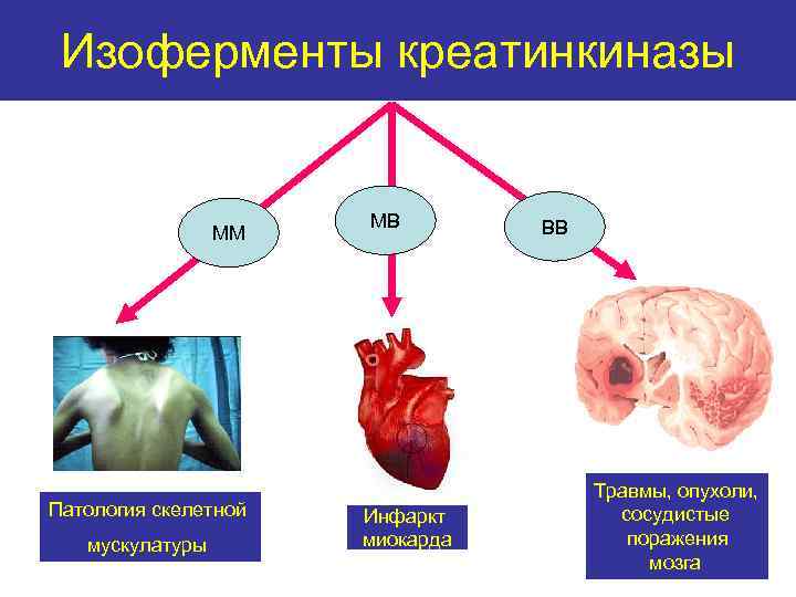 Изоферменты креатинкиназы ММ Патология скелетной мускулатуры МВ Инфаркт миокарда ВВ Травмы, опухоли, сосудистые поражения