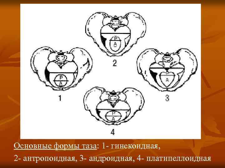 Гинекоидный таз. Классификация узкого таза Акушерство. 2 Степень сужения таза. Гинекоидная форма таза. Анатомически узкий таз классификация.