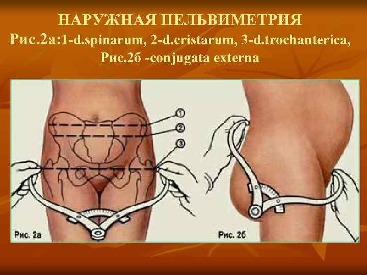 НАРУЖНАЯ ПЕЛЬВИМЕТРИЯ Рис. 2 а: 1 -d. spinarum, 2 -d. cristarum, 3 -d. trochanterica,