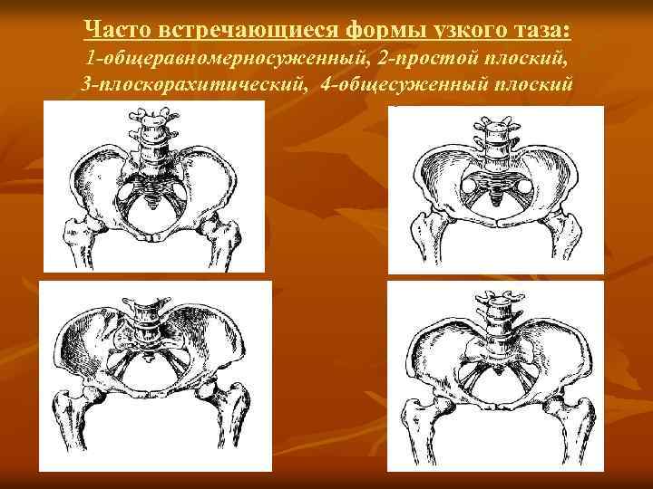 Аномалии таза презентация