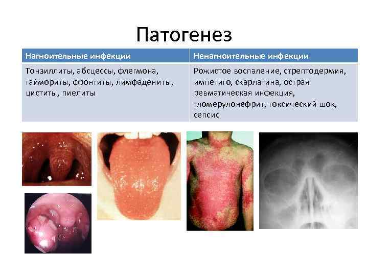 Патогенез Нагноительные инфекции Ненагноительные инфекции Тонзиллиты, абсцессы, флегмона, гаймориты, фронтиты, лимфадениты, циститы, пиелиты Рожистое