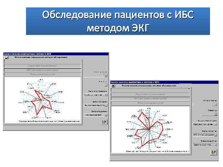 Обследование пациентов с ИБС методом ЭКГ 31 