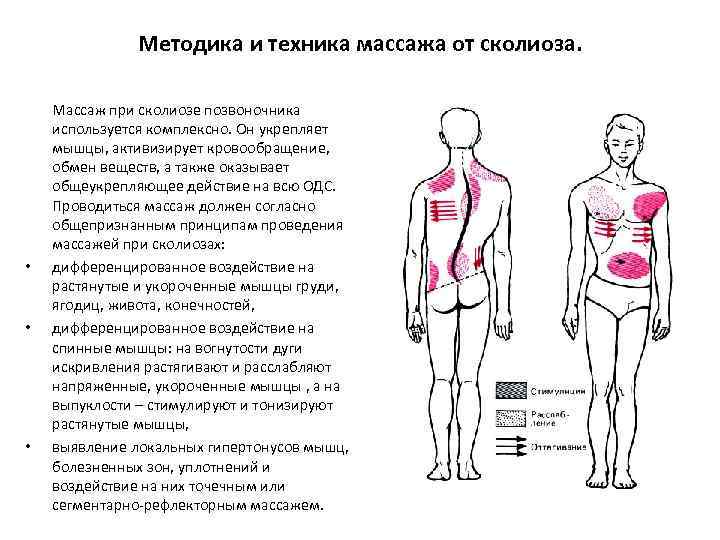 Методика и техника массажа от сколиоза. • • • Массаж при сколиозе позвоночника используется