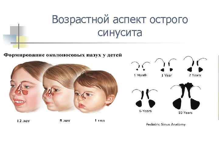 Возрастной аспект острого синусита 